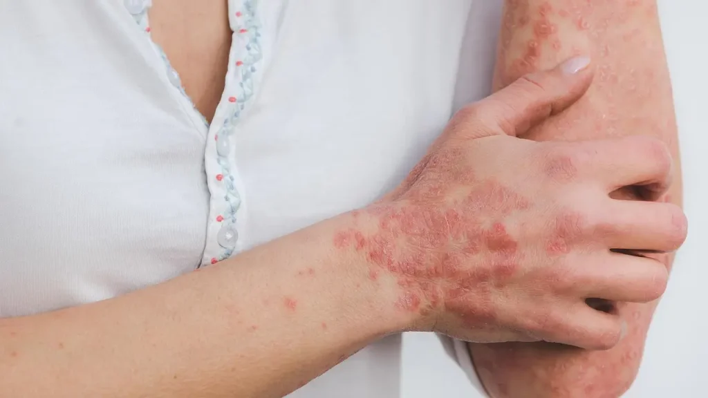 Psoriasis - Woman showing her arms