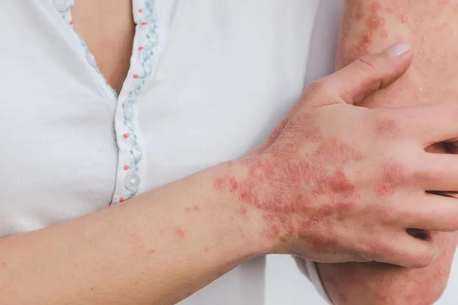 Psoriasis symptoms and skin examination