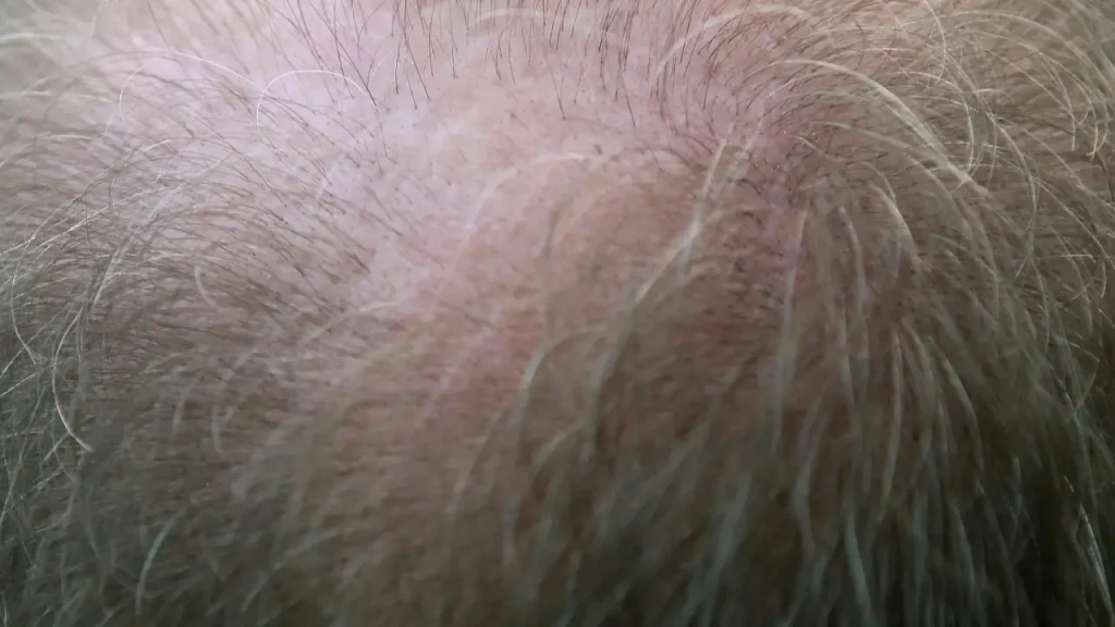 Hair loss explained with healthy and thinning hair
