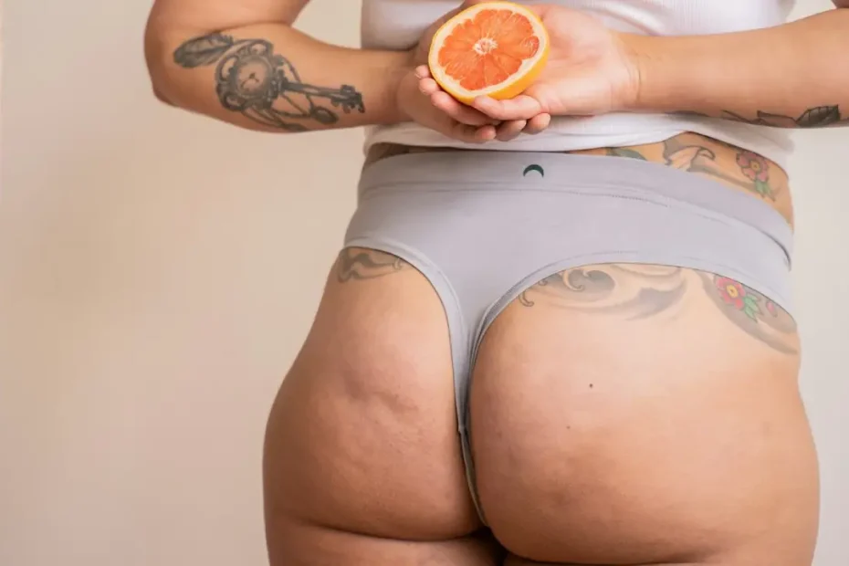 Cellulite explained with skin and connective tissue structure